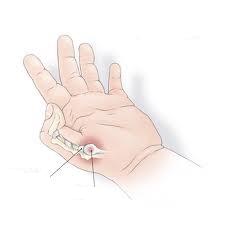 dolor en base dedo pulgar